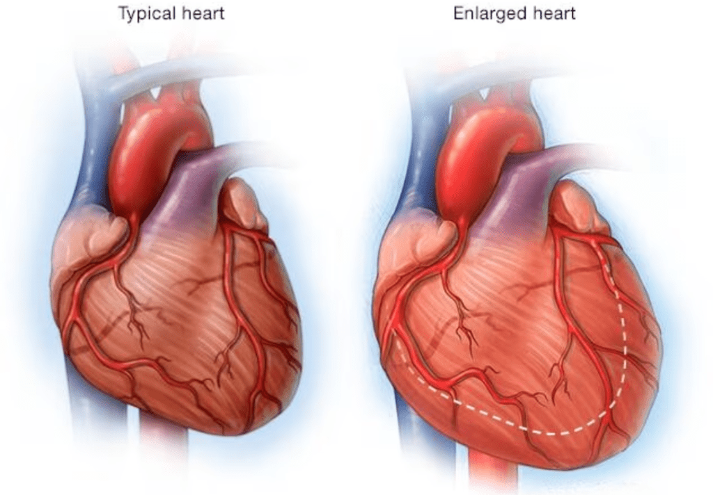 Heart enlargement